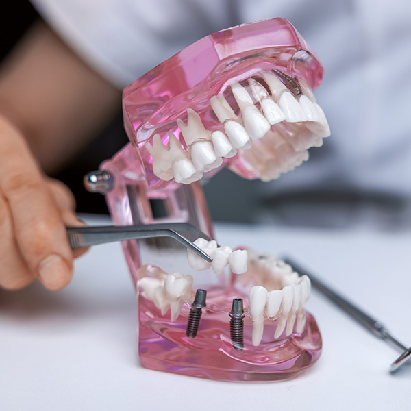 dentist implantologist showing dental bridge implant