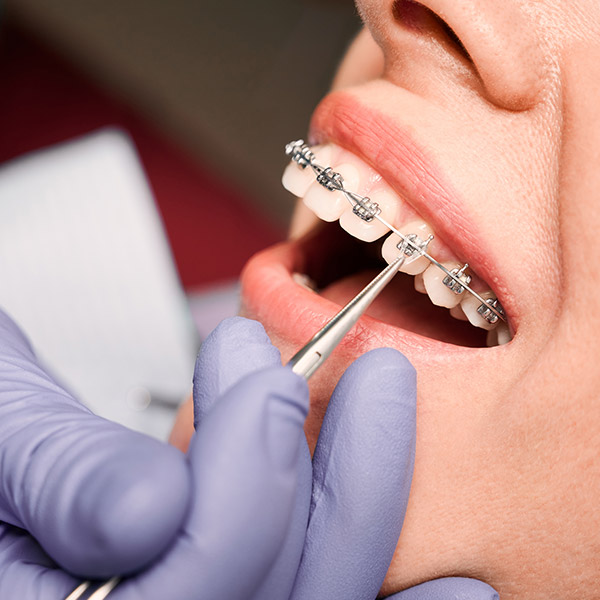 Orthodontist placing rubber bands on female patient braces